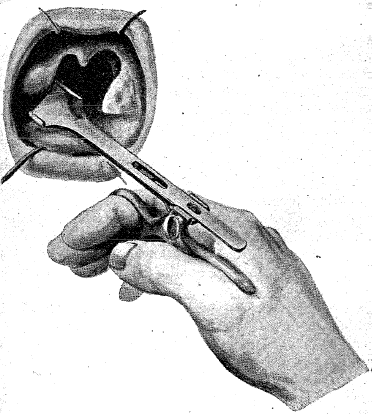 De tonsillectomie, uitgevoerd met de tonsillotoom volgens de methode-Sluder. Dit was de meest toegepaste methode.